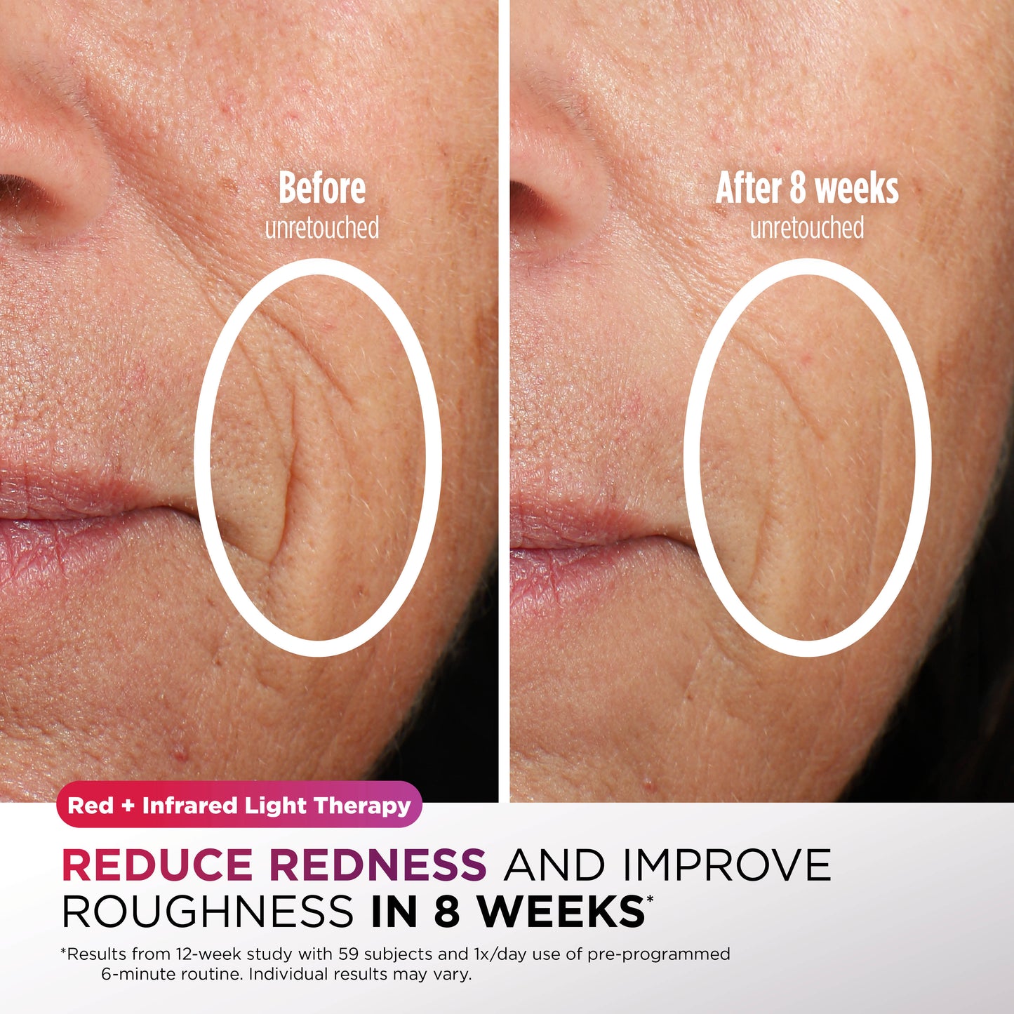 Shark CryoGlow Under-Eye Cooling + LED Mask - Lilac Chill - FW312IEPL