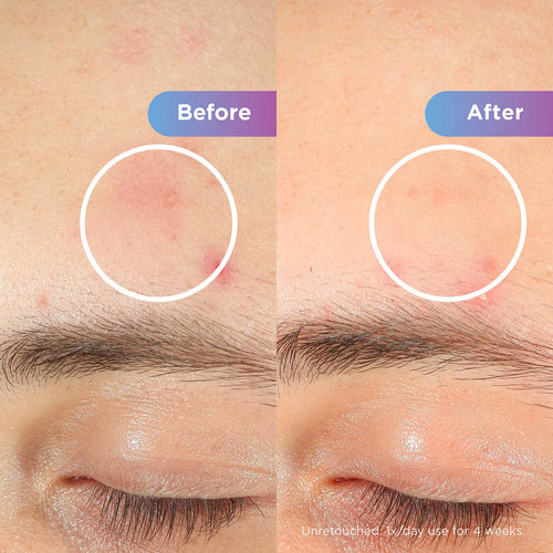 Image of LED Face Mask Before and after results